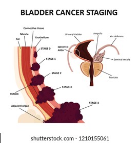 Stages Of Urinary Bladder Cancer. Classification Of Malignant Tumours. 