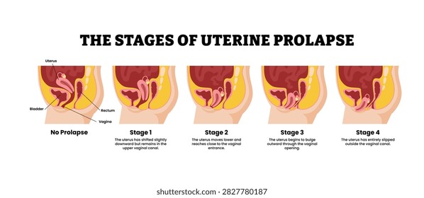 The stages of uterine prolapse stages development process. Labeled bladder, rectum, vagina, uterus. Pelvic floor muscles weakening, Support for the uterus loss.Medical science educational illustration