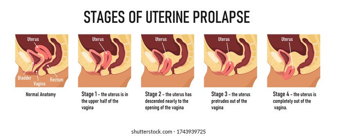 Stages Of Uterine Prolapse. Vector Illustration