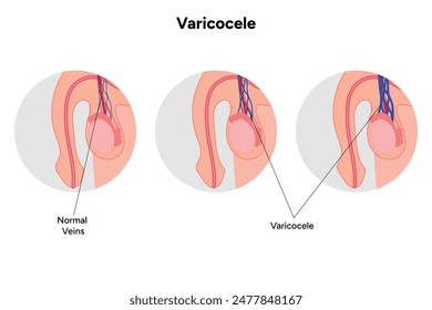 Stages of varicocele veins and normal veins