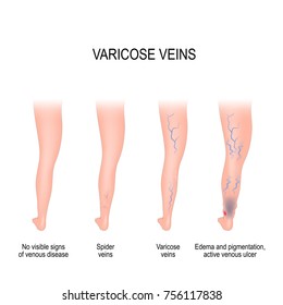 Stages of varicose: from no visible signs of venous disease to spider veins, edema, pigmentation and active venous ulcer. Normal and varicose veins. Vector diagram