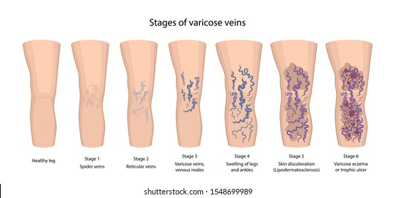 Stages of varicose veins: spider, reticular, nodes, swelling, discoloration skin, eczema, trophic ulcer. Image of healthy and diseased legs. Vector illustration in flat style with main description. 