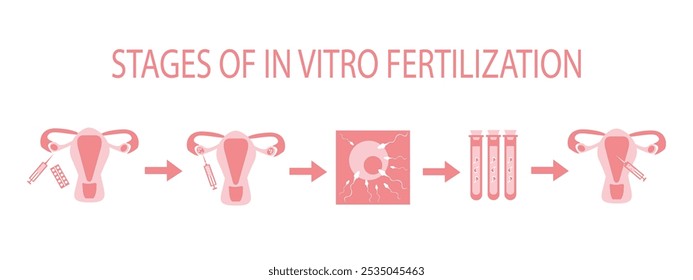 Fases de fertilização in vitro, esquema de FIV - vetor, ilustração a cores planas