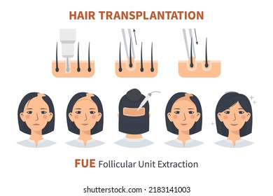 Stages of woman hair transplantation FUE Follicular Unit Extraction. Treatment of baldness, alopecia and hair loss. Vector medical infographics, a female head scalp. Strip, graft machine.