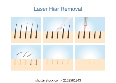 Stape of hair removal at the skin layer and follicle with shave and Laser. Illustration about epilation on the body with IPL.