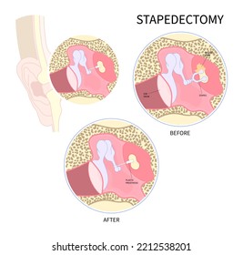 Stapedectomy Surgical For Hearing Loss And Meniere's Syndrome Balance Problem