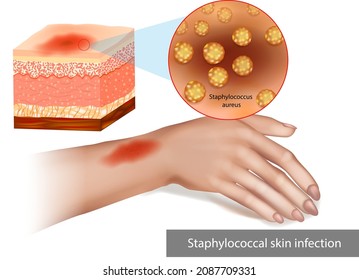 Staphylococcal skin infection or Staph infection. Superimposed bacterial infection Skin cellulitis.