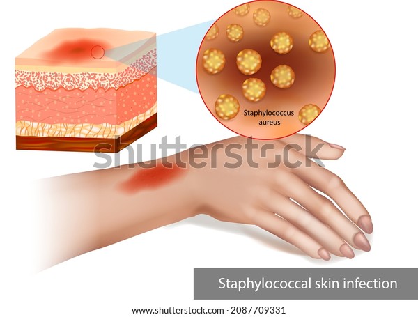 Staphylococcal Skin Infection Staph Infection Superimposed Stock Vector