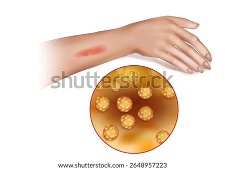 Staphylococcus Aureus Skin Infection with Close-Up Bacteria View. Bacterial Skin Lesion Caused by Staphylococcus Aureus on Human Arm