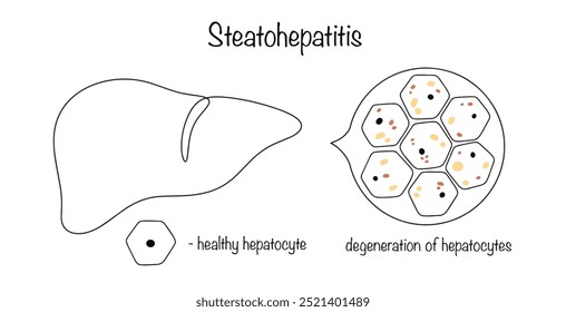 Steatohepatitis. Inflammatory process of the liver against the background of its fatty degeneration. hand drawn liver with modified hepatocytes. Vedic vecto on a spruce background.