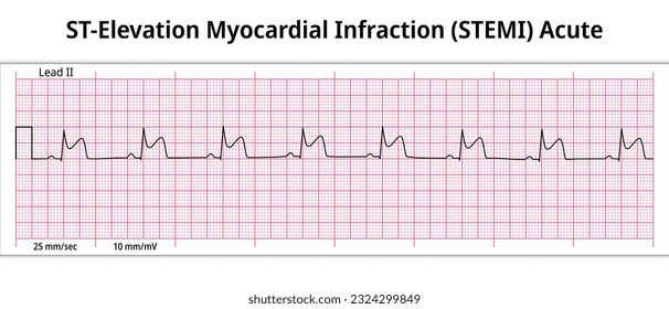 ST-Elevation Myocardial Infarction (STEMI) Acute - 8 Second ECG Paper - Electrocardiography Vector Medical Illustration