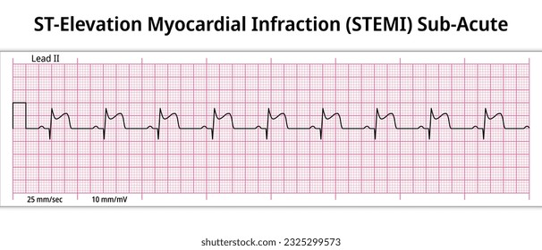 ST-Elevation Myocardial Infarction (STEMI) Sub-Acute - 8 Second ECG Paper - Electrocardiography Vector Medical Illustration