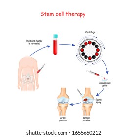 Stem Cell Therapy. Before And After Of Sports Injury. Human Knee Joint