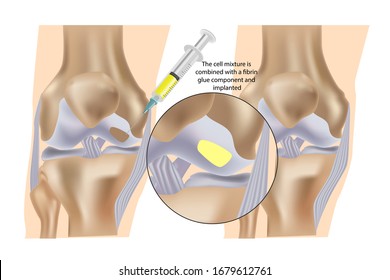 Stem Cell Therapy ( Injections) For Repair Of Knee Cartilage.The Cell Mixture Is Combined With A Fibrin Glue Component And Implanted.