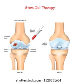 Stem Cell Therapy For Pain In Osteoarthritis Knees And Hips Use The Healing Properties Of Your Own Cells, Taken From Your Bone Marrow Or Adipose Fat To Rebuild Your Damaged Joints. Stem Cell Injection