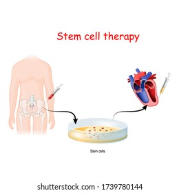 Stem Cell Therapy From Pelvis To Heart. Vector Diagram For Medical And Science Use.