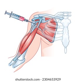 Stem cell therapy as regenerative medicine for tissue repair outline diagram. Educational example with treatment and injection to help diseased, dysfunctional or injured tissues vector illustration.