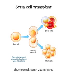 Stem Cell Transplant. Stem Cells Divide And Change Into The Different Types Of Blood Cells. Vector Illustration