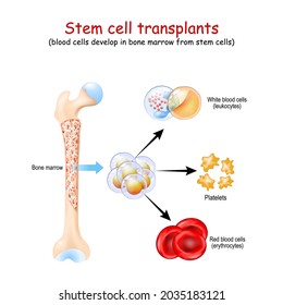 Stem Cell Transplants. Blood Cells Develop In Bone Marrow From Stem Cells. Erythrocytes, Leukocytes And Platelets