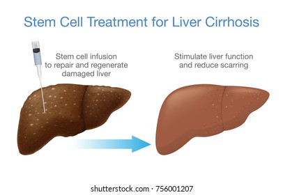 liver stem cell treatment