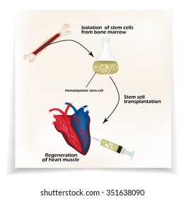 Stem cells from bone marrow is used to regenerate the cardiac muscle. Infographics. Vector illustration.