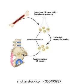 Stem cells from bone marrow are used for bone regeneration. Infographics. Sacral region, sacrum. Vector illustration.