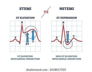 STEMI vs NSTEM heart beat impulse in cardio visualization outline diagram. EKG or electrocardiogram with ST elevation and depression comparison vector illustration. Myocardial infarction example.