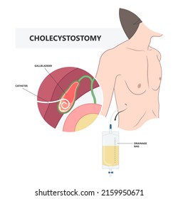 Stent Acute Guided ERCP ERGD Drain Surgical Laparoscopy Tube Bile Duct Stone Bag Liver Blocked Obstruction Pain Yellow Skin Eye Remove Examine Cancer Colic Injury Rupture Tumor