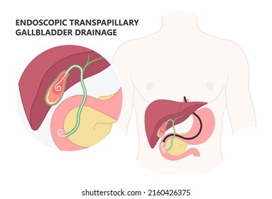 Stent Acute Guided ERCP ERGD Drain Surgical Laparoscopy Tube Bile Duct Stone Bag Liver Blocked Obstruction Pain Yellow Skin Eye Remove Examine Cancer Colic Injury Rupture Tumor