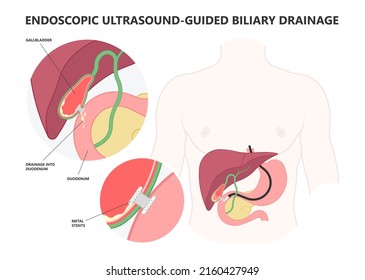 Stent Acute Guided ERCP ERGD Drain Surgical Laparoscopy Tube Bile Duct Stone Bag Liver Blocked Obstruction Pain Yellow Skin Eye Remove Examine Cancer Colic Injury Rupture Tumor