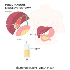 Stent Acute Guided ERCP ERGD Drain Surgical Laparoscopy Tube Bile Duct Stone Bag Liver Blocked Obstruction Pain Yellow Skin Eye Remove Examine Cancer Colic Injury Rupture Tumor