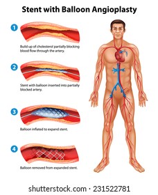 A stent angioplasty procedure