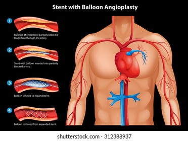 Stent with balloon Angioplasty illustration