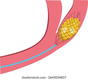 Stenting para el cerebro: Una guía para el cuidado del paciente