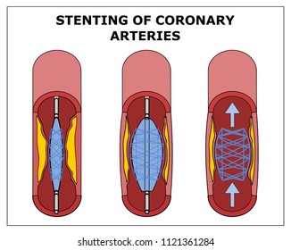 STENTING OF CORONARY ARTERIES VECTOR SCHEME