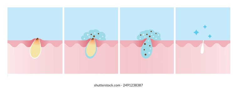 Paso de Ilustración vectorial del proceso de tratamiento de espinillas de acné. Aplique ácido salicílico en la capa de piel, penetre en la piel para disolver las células muertas de la piel que obstruyen los poros y disminuir el enrojecimiento y la hinchazón.