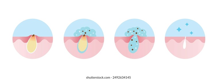 Step of acne pimple treatment process vector icon set illustration. Apply salicylic acid on blackhead, penetrate into skin to dissolve the dead skin cells clogging pore and keeping pores clear.