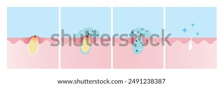 Step of acne pimple treatment process vector illustration. Apply salicylic acid on skin layer, penetrate into skin to dissolve the dead skin cells clogging pore and decrease redness and swelling.