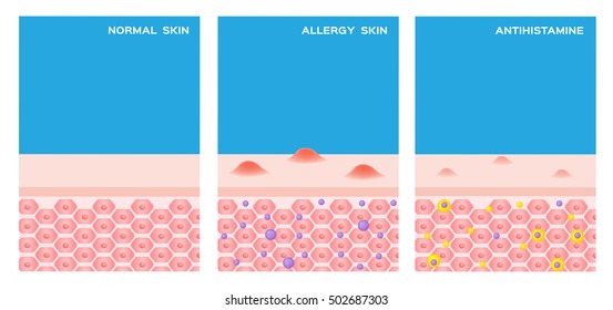 step of allergy skin before and after taking a medicine vector 