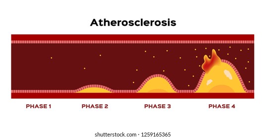 step of Atherosclerosis graphic vector . fat stuck in the blood artery cholesterol