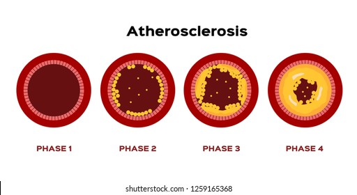 step of Atherosclerosis graphic vector . fat stuck in the blood artery cholesterol