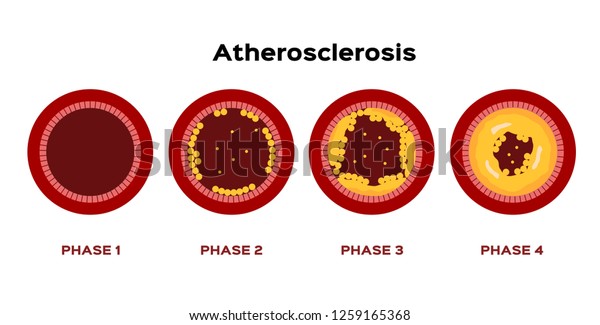 アテローム性動脈硬化の図形ベクター画像の手順 血動脈コレステロールに付着した脂肪 のベクター画像素材 ロイヤリティフリー 1259165368