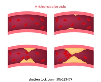 step of Atherosclerosis icon and vector . fat stuck in the blood artery . cholesterol
