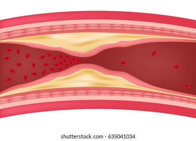 step of Atherosclerosis icon and vector . fat stuck in the blood artery  cholesterol