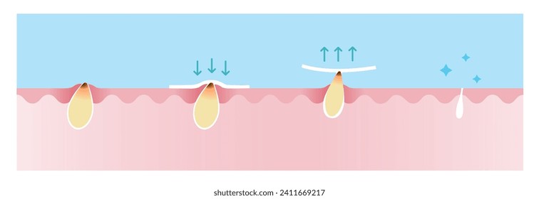 Paso de la ilustración vectorial de eliminación de la cabeza negra en el fondo azul del cielo. Sección transversal del tratamiento de la franja porosa de la cabeza negra, aplicar, pelar, desobstruir y apretar el poro. El cuidado de la piel y el concepto de belleza.
