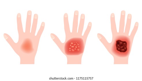 step of burn . Normal to serious burn skin . vector and icon / hand