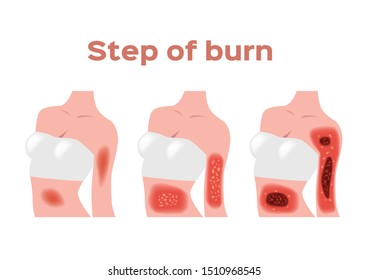 step of burn . Normal to serious burn skin . vector and icon / body chest and arm