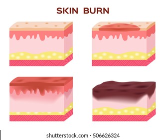 Step Of Burn . Normal To Serious Burn Skin . Vector And Icon