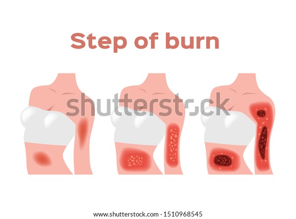 Step Burn Normal Serious Burn Skin Stock Vector (Royalty Free) 1510968545