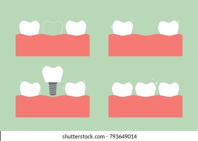 step of caries to dental implant with crown, before and after - tooth cartoon vector flat style cute character for design